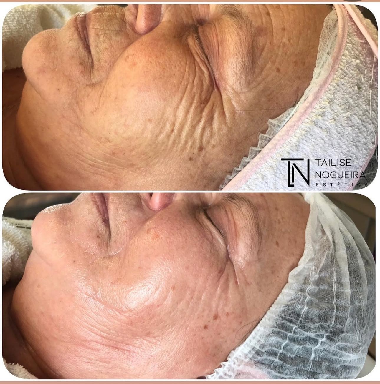 Antes e Depois - Olhos