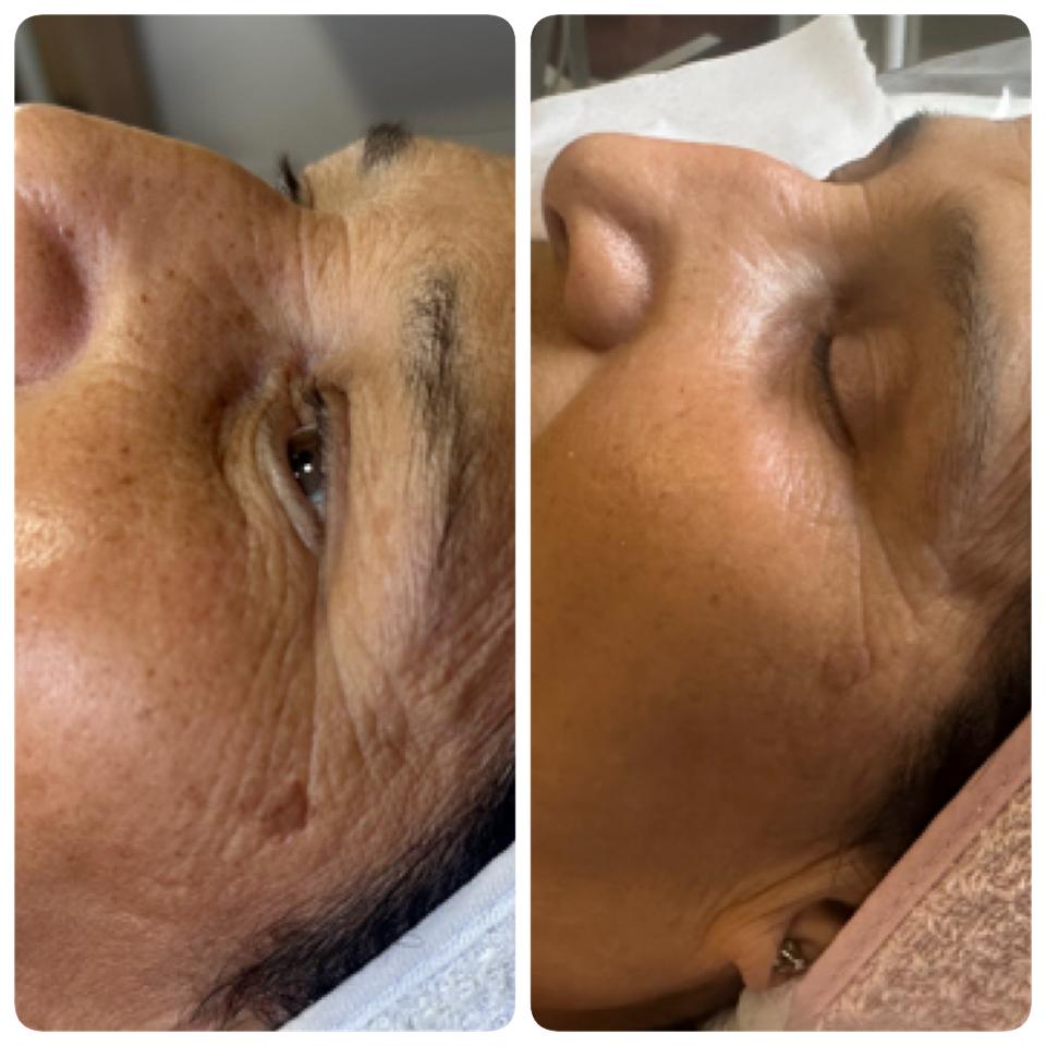 Antes e Depois - Testa